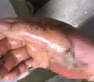 睡梦中，灼热的刺痛传来，差点让她没了命！这个睡前习惯，快改！