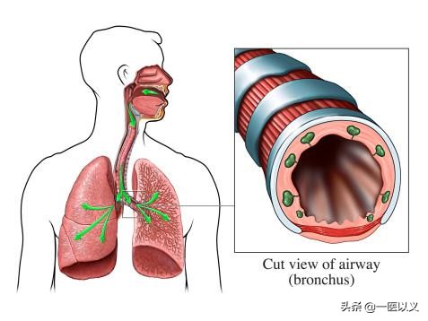 肺气肿慢阻肺最佳治疗方案,慢阻肺肺气肿稳定期怎么治疗
