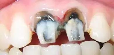 烤瓷牙可以解决牙齿不齐问题吗,烤瓷牙能修复吗