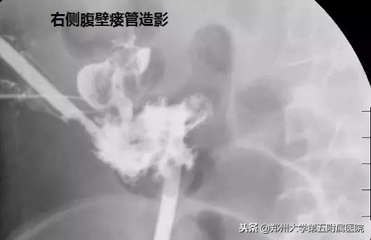 十来年肠绞痛的表现和处理方法,十年腹痛