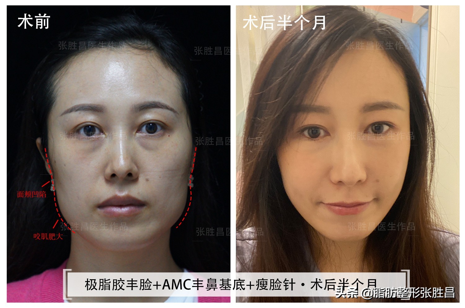 一次瘦脸针能维持多久,瘦脸针一次可以维持多久