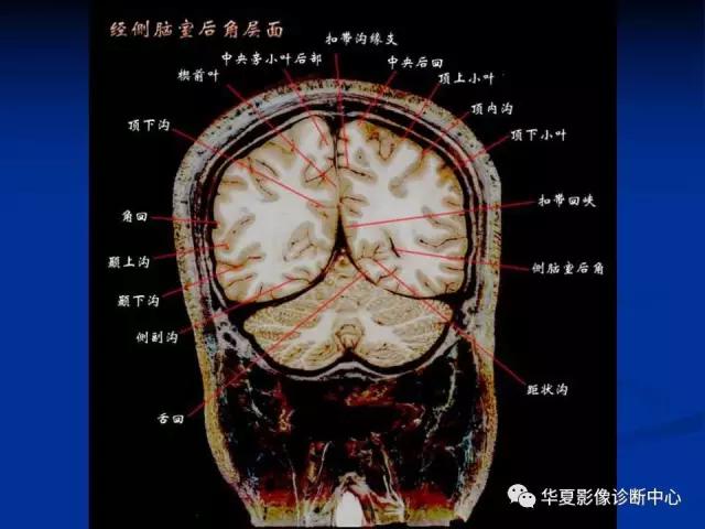 mra头颅解剖学详细讲解视频,常见的头颅mri图像