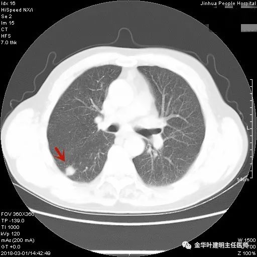 叶建明谈实性结节,叶建明肺实性良性结节会变癌症吗