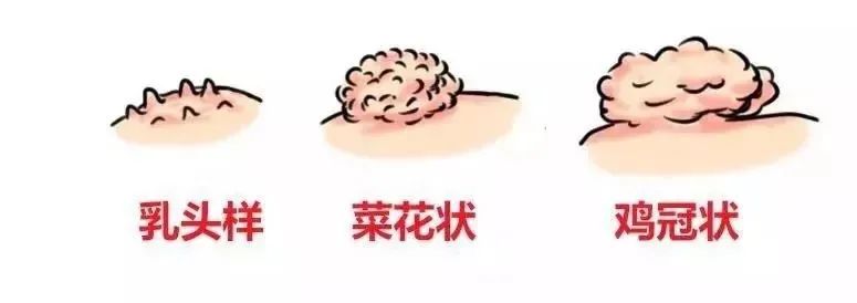 嫖娼、乱性等行为不仅有违道德和法律还可能带来各种各样的性病