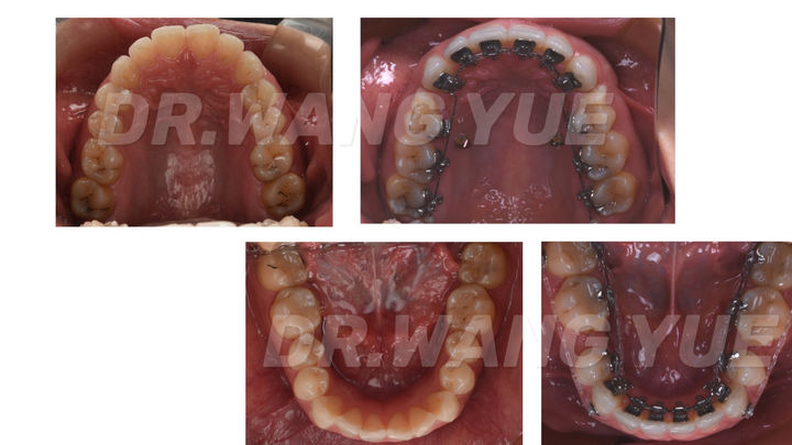上海口腔医院牙齿矫正牙缝,上海牙齿畸形龅牙矫正