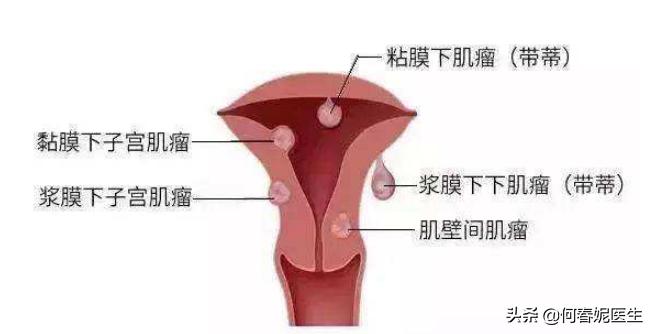 警惕子宫肌瘤剔除术后复发！3种方式可有效预防