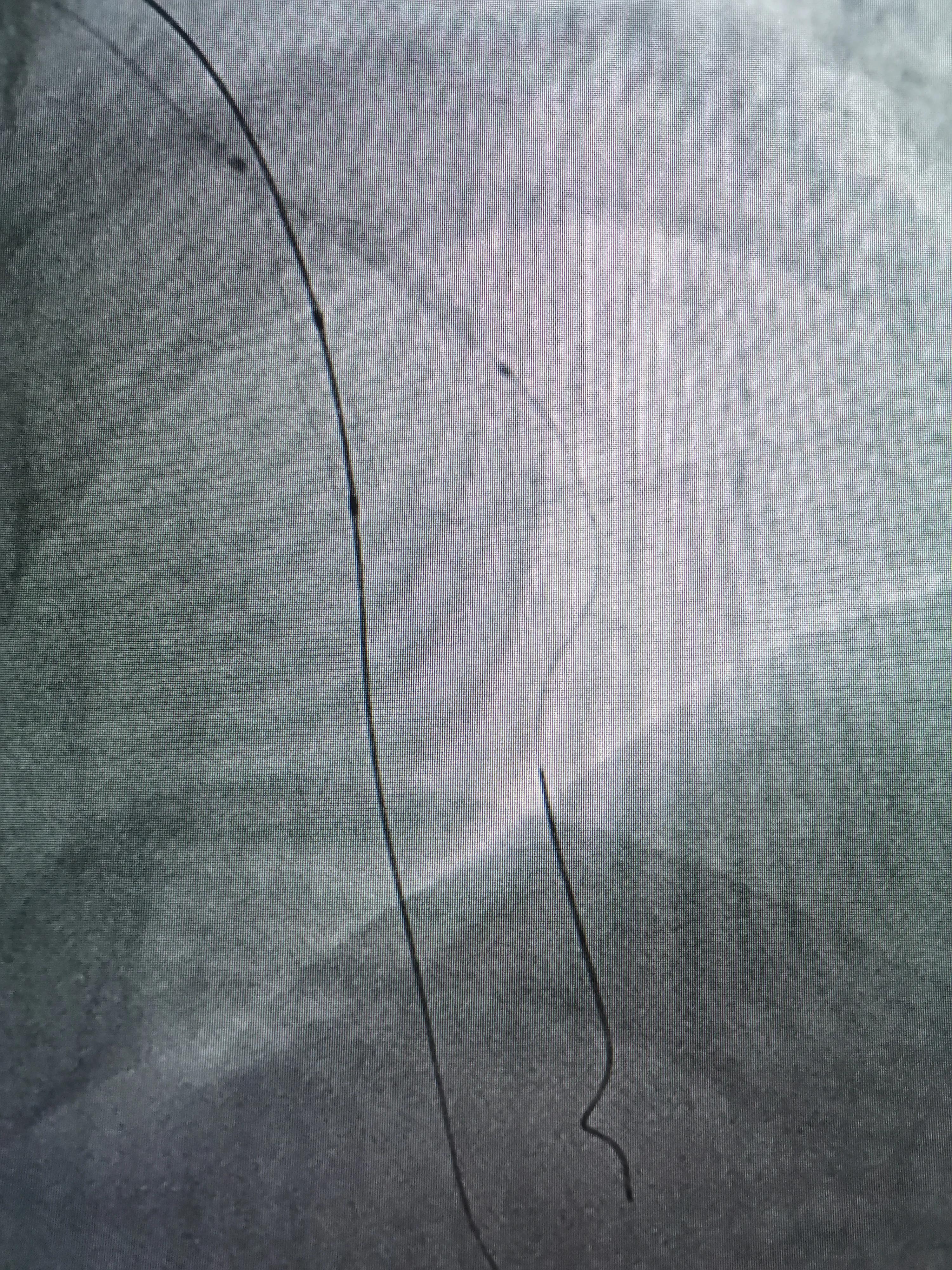 atp术式治疗冠脉分叉病变,冠脉分叉处堵塞能治吗