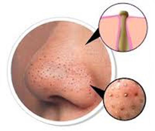 原来脸上的痘痘取决于心情,原来痘痘反复长是这些原因导致的