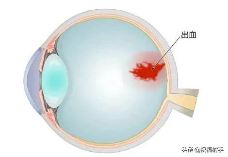 专家谈老年飞蚊症的治疗,飞蚊症老年人