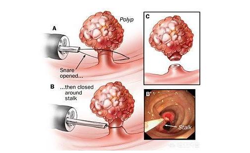 肠镜切息肉需要麻醉吗,肠镜中发现息肉是在手术中切除吗