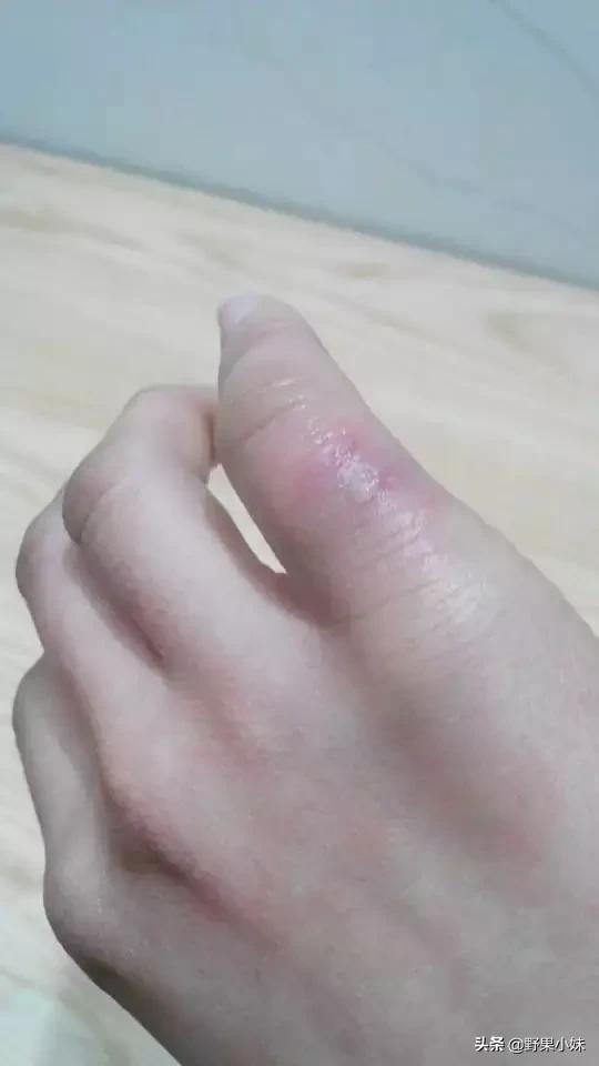 冻疮是怎么形成的原因是什么,冻疮严重溃烂的怎么治