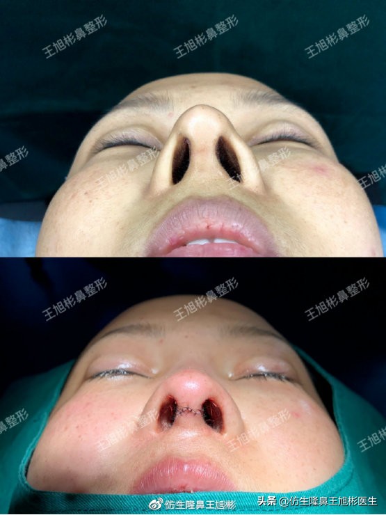 歪鼻可以用什么方法矫正,歪鼻矫正的危害