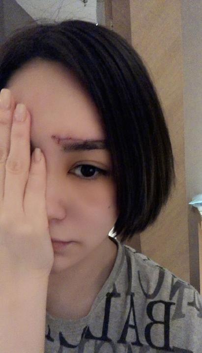 医美专家爆阿娇6㎝伤口肯定留疤痕，激光也难以恢复平滑肌肤