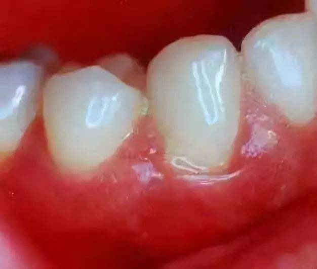 一碰就出血不易止住,轻轻一碰就出血是什么原因