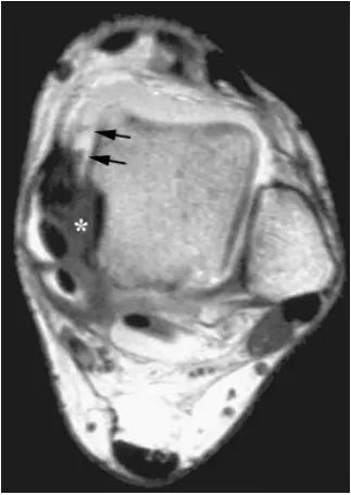 踝关节撞击症问诊,踝关节内侧撞击综合症位置图