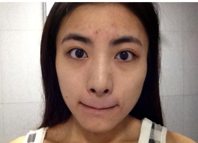 皮肤粗糙暗沉毛孔粗大什么原因,鼻子两侧毛孔粗大是什么原因