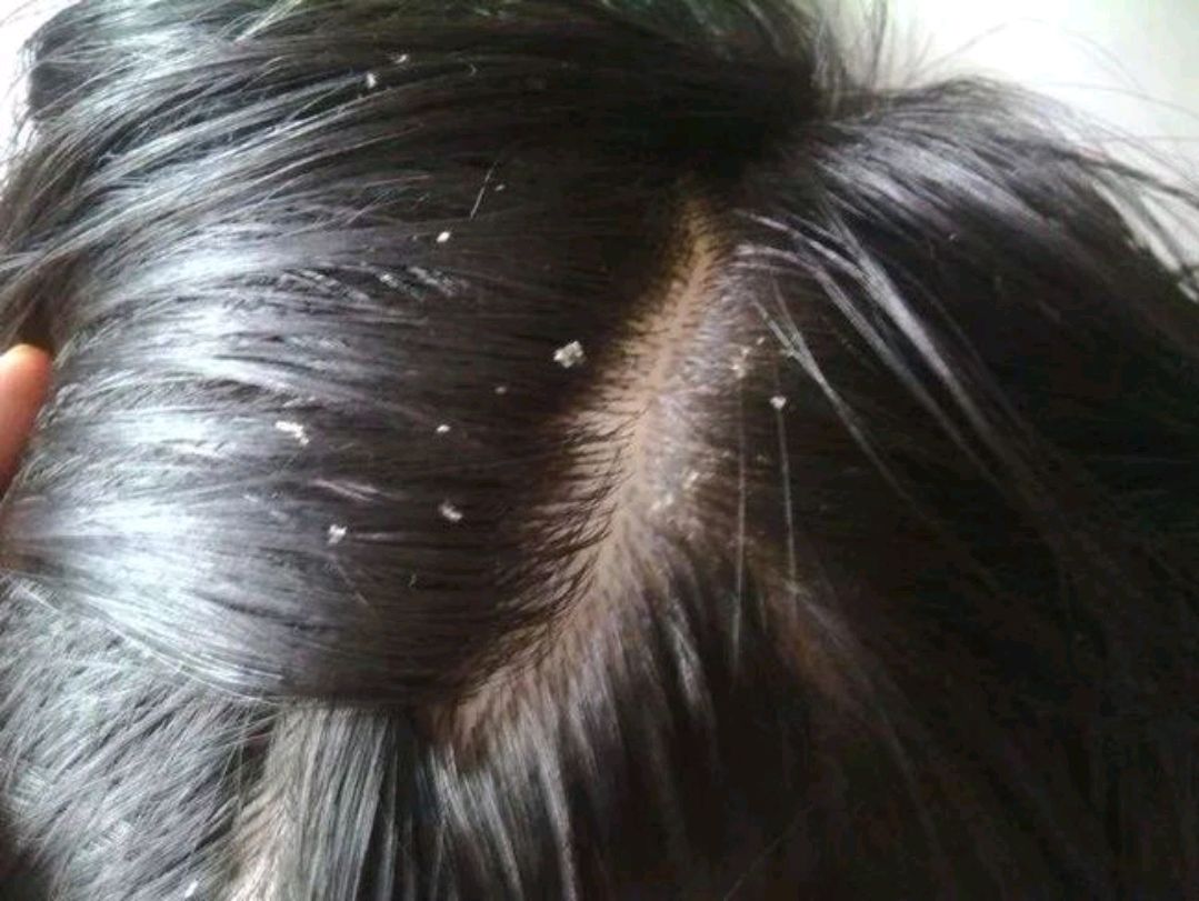 头皮上的白泥有必要除掉吗,头皮上的白泥如何解决