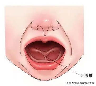 孩子说话不清晰，咬音不准。是“舌系带”过短导致的么？
