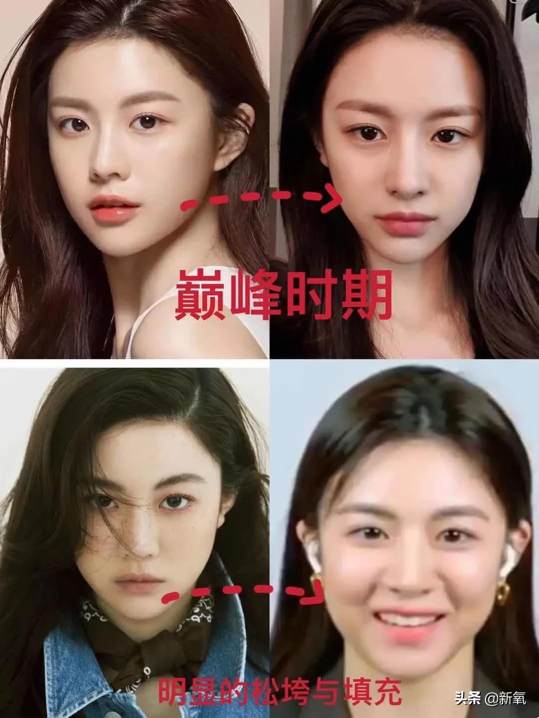 脸松弛下垂做哪种整形,面部下垂整形方法