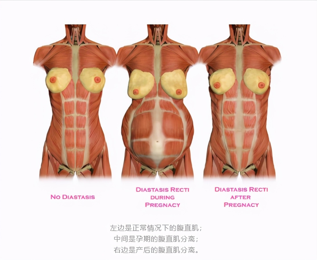 产后肚子膨隆,生完肚子会变小吗