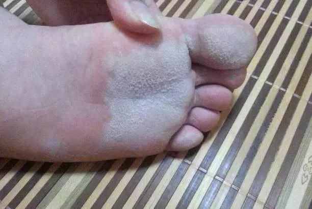 阿司匹林生活小技巧,阿司匹林正确吃法消炎