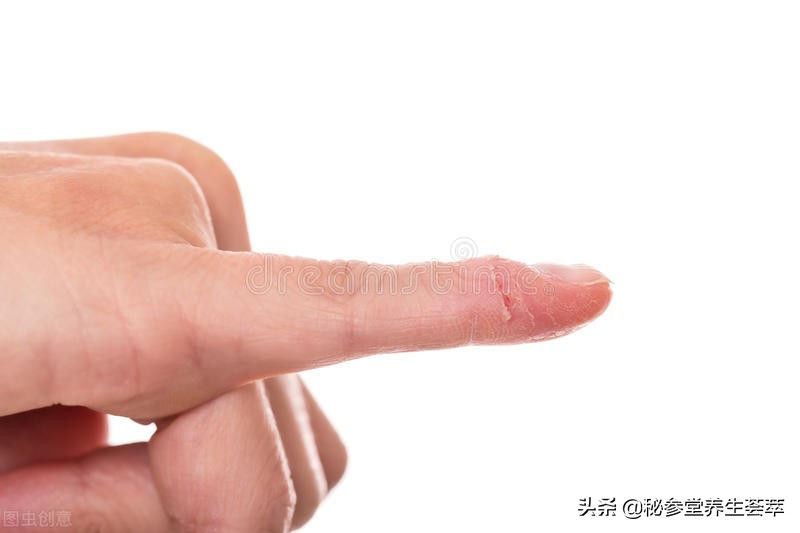 甲沟炎引流排脓疼吗,甲沟炎有脓怎么排脓儿童