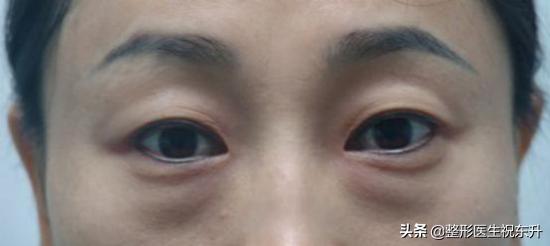 祛眼袋术后脸肿得很厉害怎么办,祛眼袋术后多久可以做皮秒