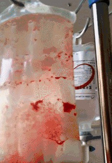 花三万换血15次,一周两次换血净化血液垃圾