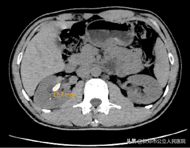 尿结石腰疼说明石头在哪里卡着呢,腰疼得厉害小便血尿是怎么回事
