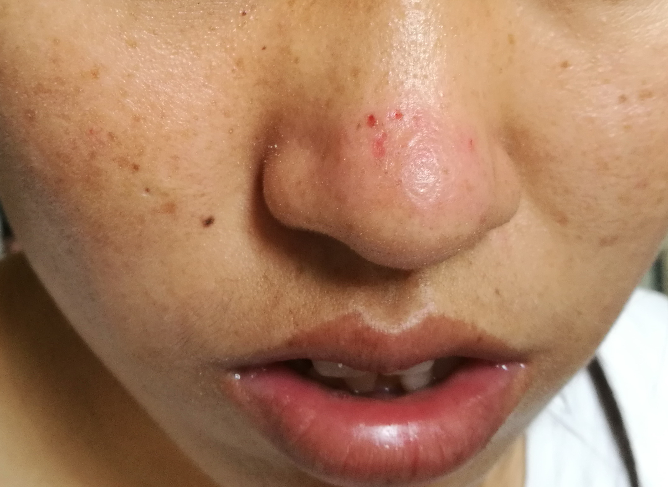 光过敏/多形性日光疹