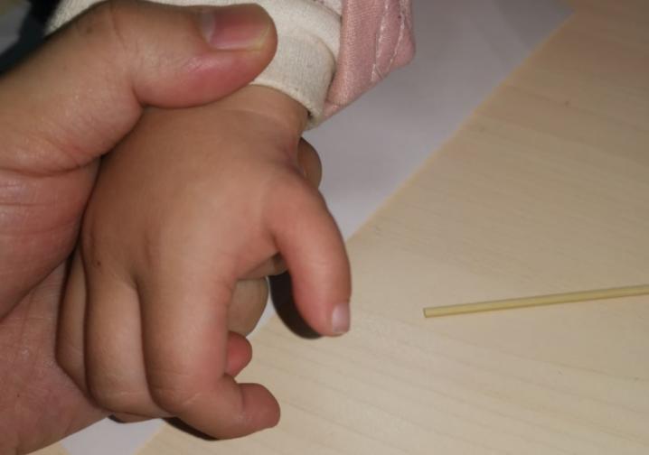 漂浮拇：成功保五指|案例5《左手多指右手漂浮拇，拇指成功搬家》