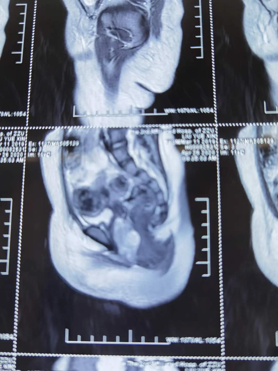 女宝宝外阴长了肿瘤怎么治疗,小孩易发妇科肿瘤