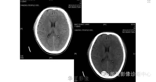 一文读懂颅内胆脂瘤,一文看懂背后的真相