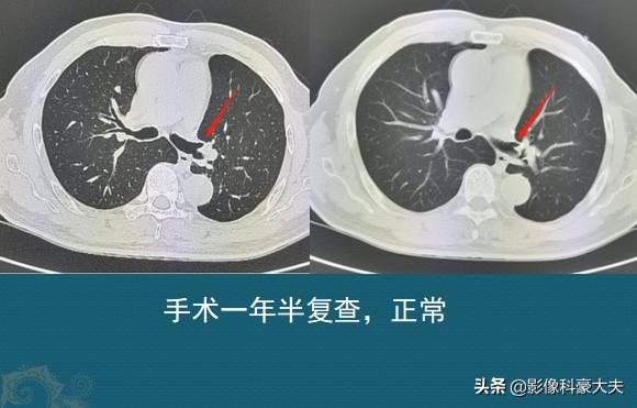 为什么腰部骨折要做心电图,骨折为什么要拍脑ct