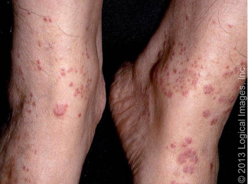 过敏性紫癜算是风湿病的一种吗,风湿性关节炎与过敏性紫癜区别