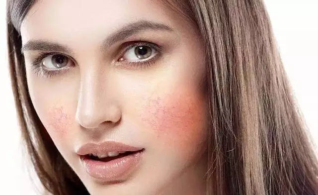 脸起皮干燥紧绷刺痛发红?这三个敏感肌护理误区你一定要远离