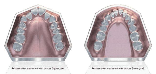 正畸主治学习视频,正畸钟摆效应名词解释