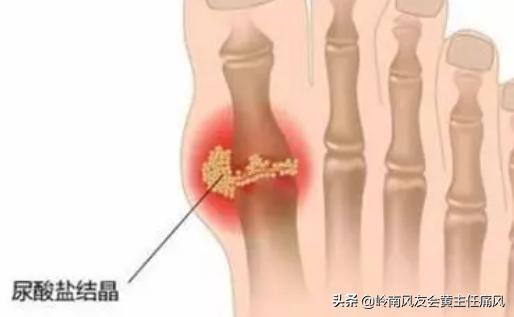有哪些症状的人容易得高尿酸血症,尿酸高的人身上会有四种迹象