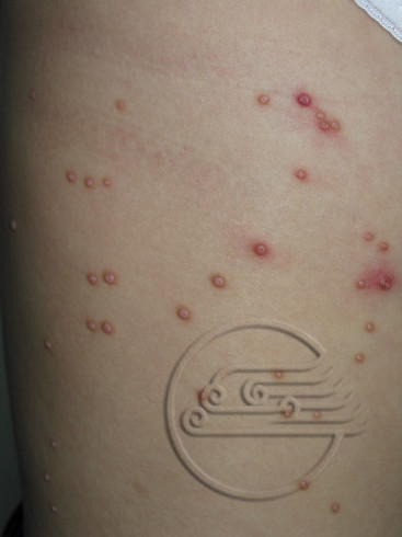 传染性软疣儿童怎么治可以断根,儿童脸上长了传染性软疣怎么办