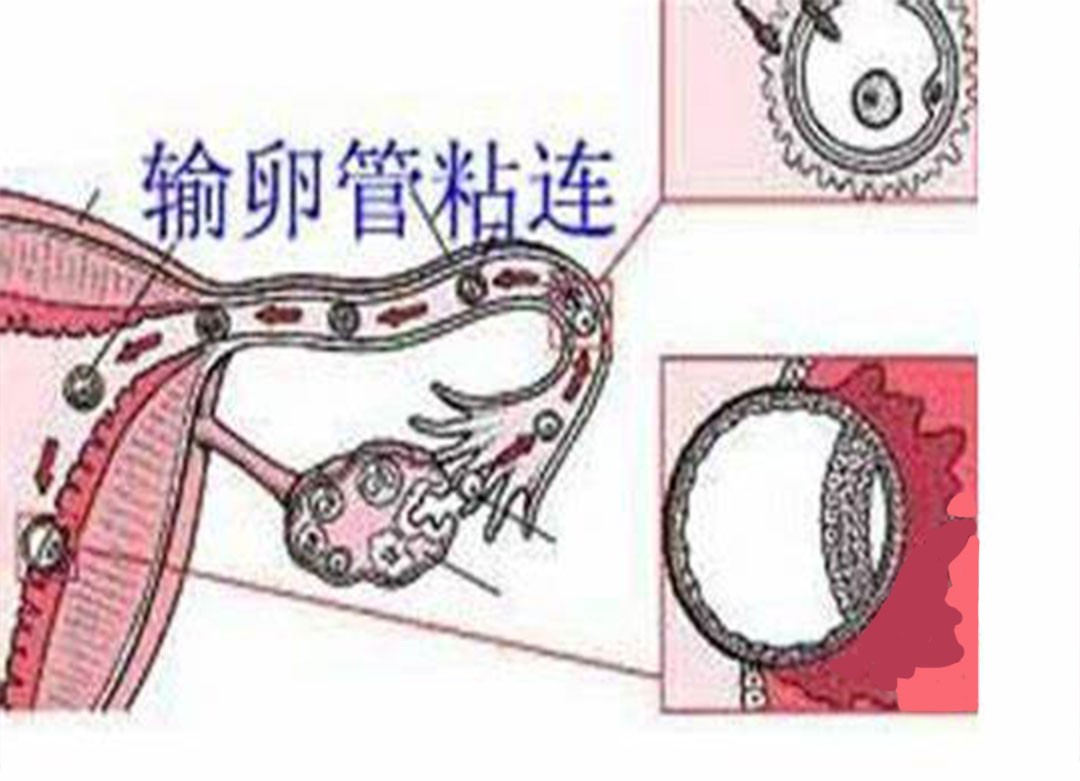 输卵管不孕是怎么回事？一篇文章搞懂输卵管不孕