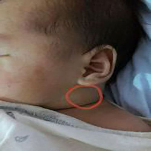 什么是川崎病,什么是川崎病小儿