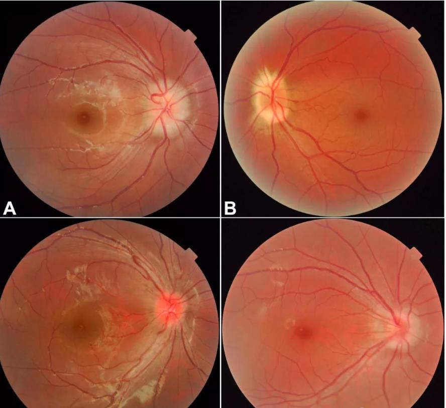 颅高压第一篇:视乳头水肿