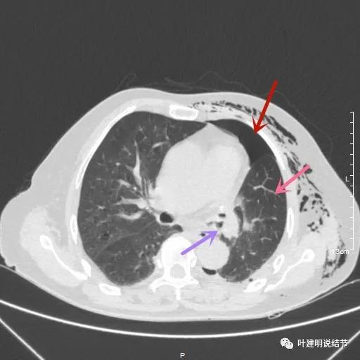 中央型肺癌手术前辅助治疗,中央型肺癌治疗后活过10年的病例