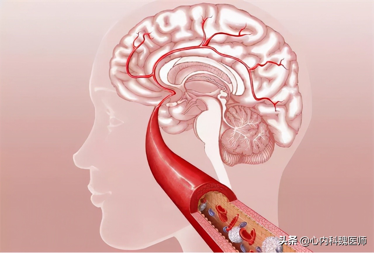 低压高高血压如何选择降压药,血压低压93应吃什么药降压