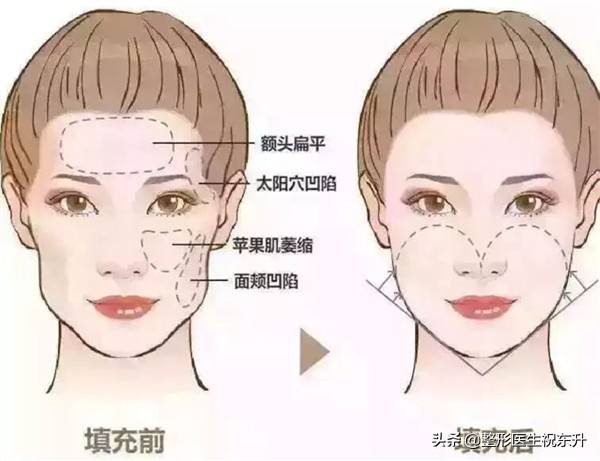 脂肪填充不要轻易尝试,脂肪填充面部不对称怎么办