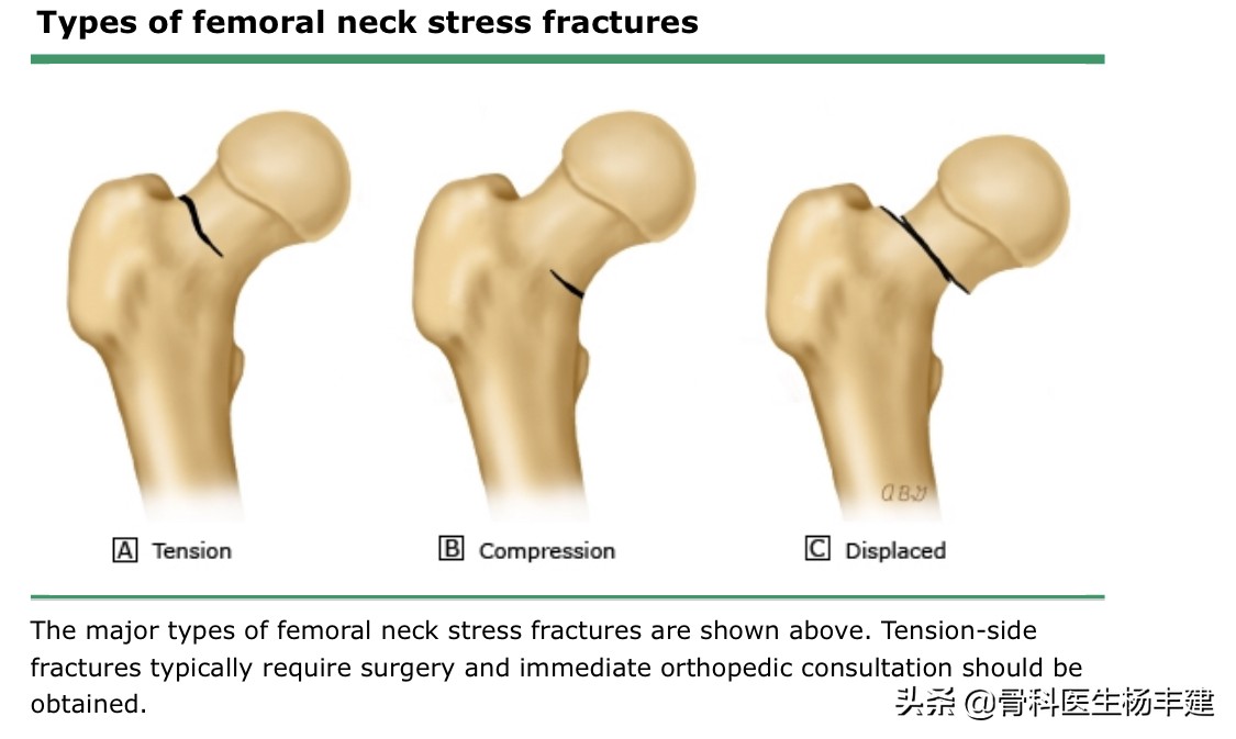 老年人常见的髋部损伤有哪些,跑步的常见损伤之髋关节