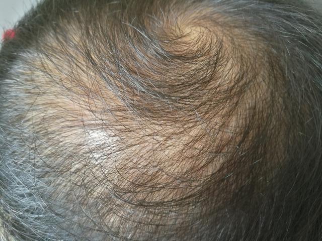 病理性脱发,偏执性脱发