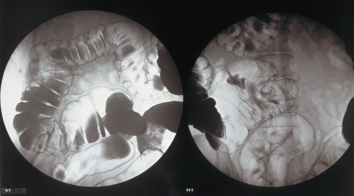 听说过结肠癌、直肠癌,那结直肠癌的结直肠在哪里?