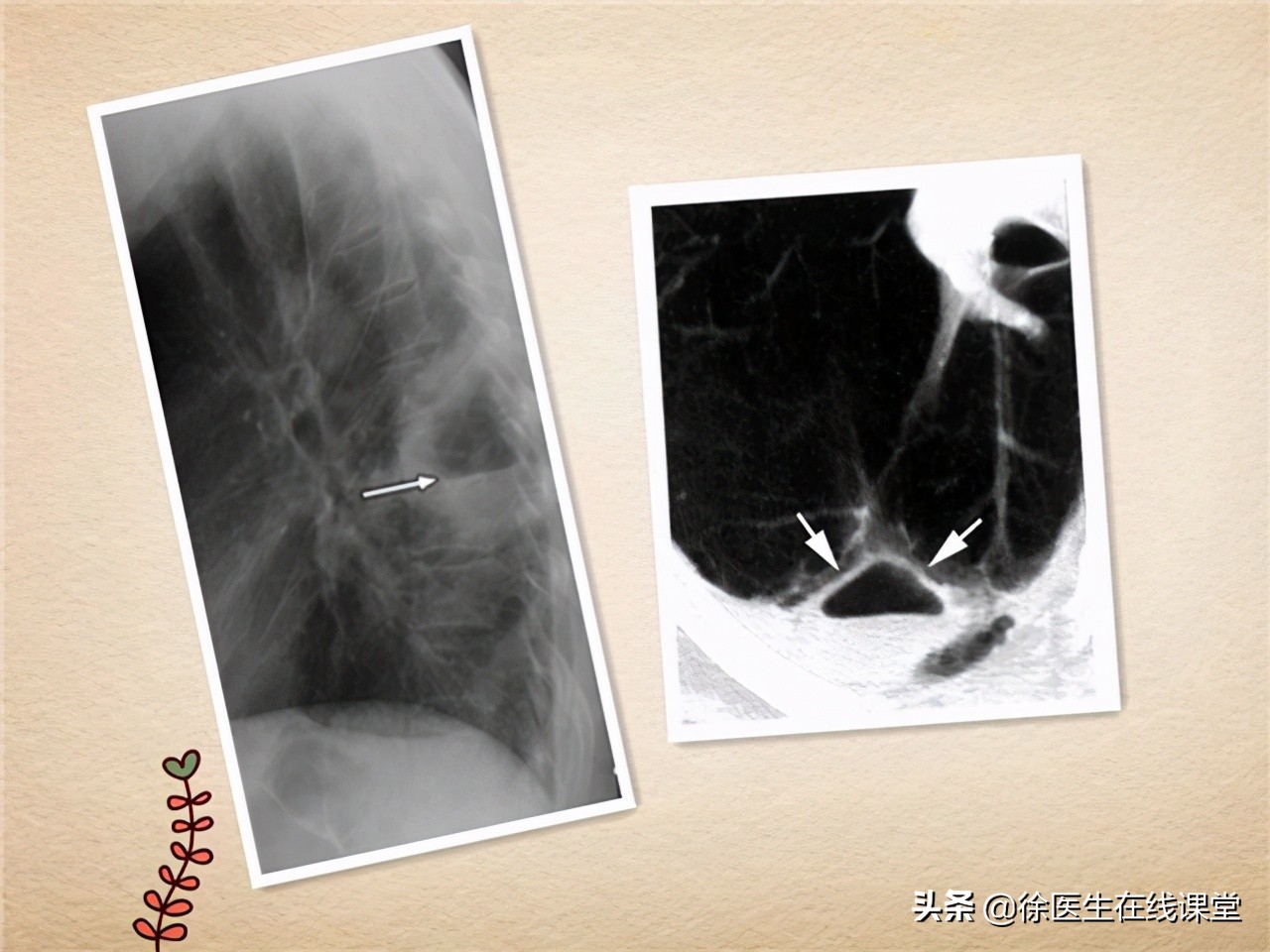 肺脓肿是局限性化脓性炎吗,急性肺脓肿与其他疾病鉴别