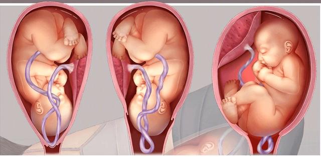 住院时突发脐带脱垂，来不及打麻药，绑住胳膊腿，直接剖腹产